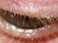 wimperrand ontsteking Blefaritis