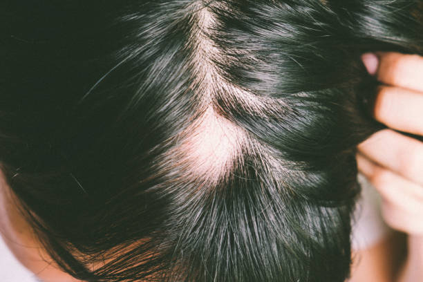 alopecia kale plekken in haar