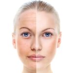 Microneedling Bianca Lochem