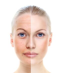 Microneedling Bianca Lochem