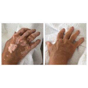 medische camouflage vitiligo