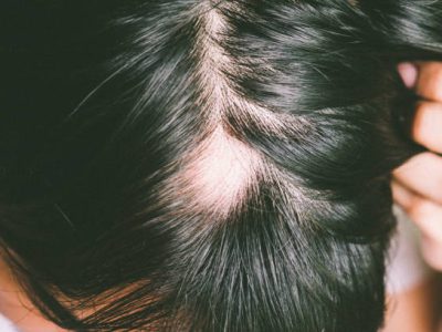 alopecia kale plekken in haar