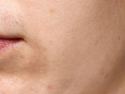 huid is vlekkerig droge plekjes schilferig