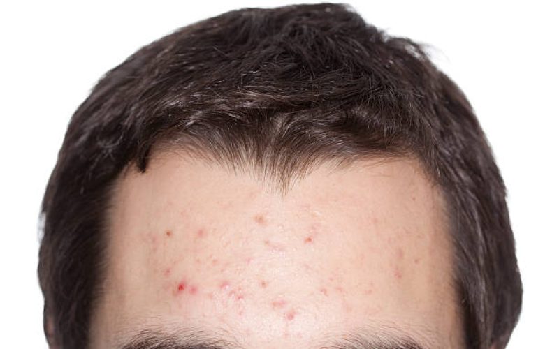 acne specialisatie