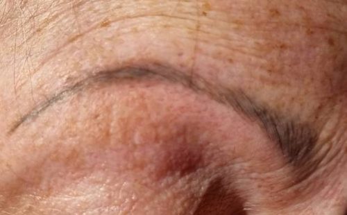 A close-up photo where a missing eyebrow has been reconstructed with a permanent make-up of the eyebrow, where you can see the individual hair straw painted.