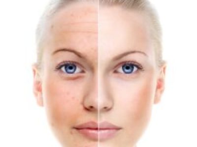 Microneedling Bianca Lochem