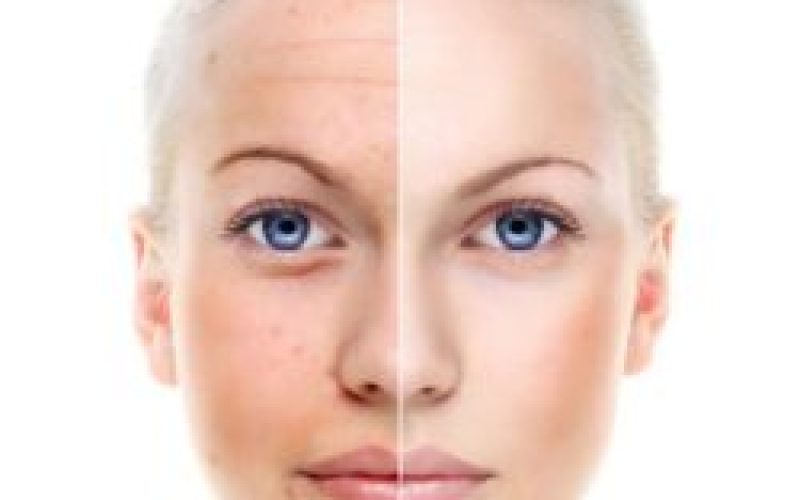 Microneedling Bianca Lochem