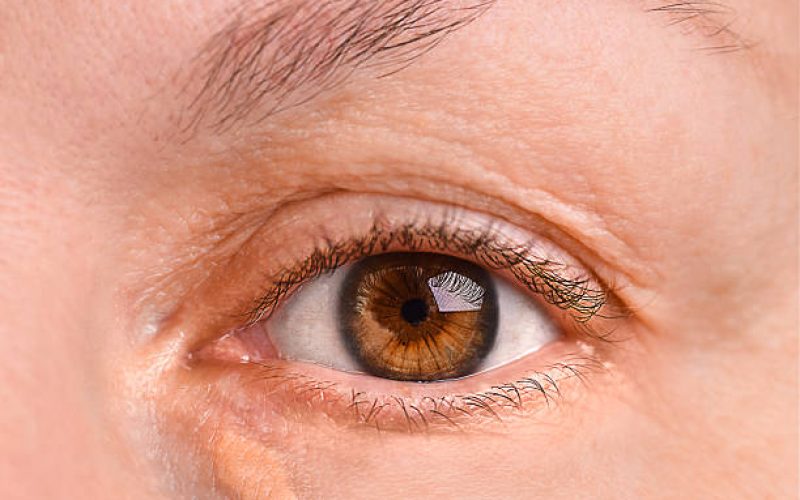 “Syringomen en xanthelasma rond de ogen – voorbeeld van goedaardige huidbultjes en bindweefselafwijkingen behandelbaar bij Schoonheidssalon Bianca Lochem.”